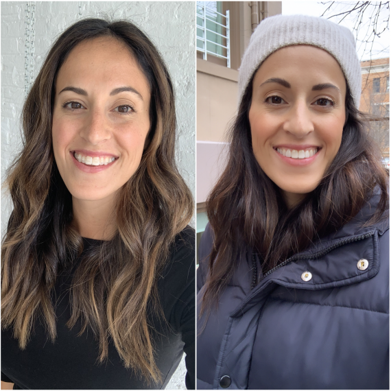 Ali's Invisalign Before and After results