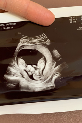 Pregnant with Twins, First Trimester ultrasound image