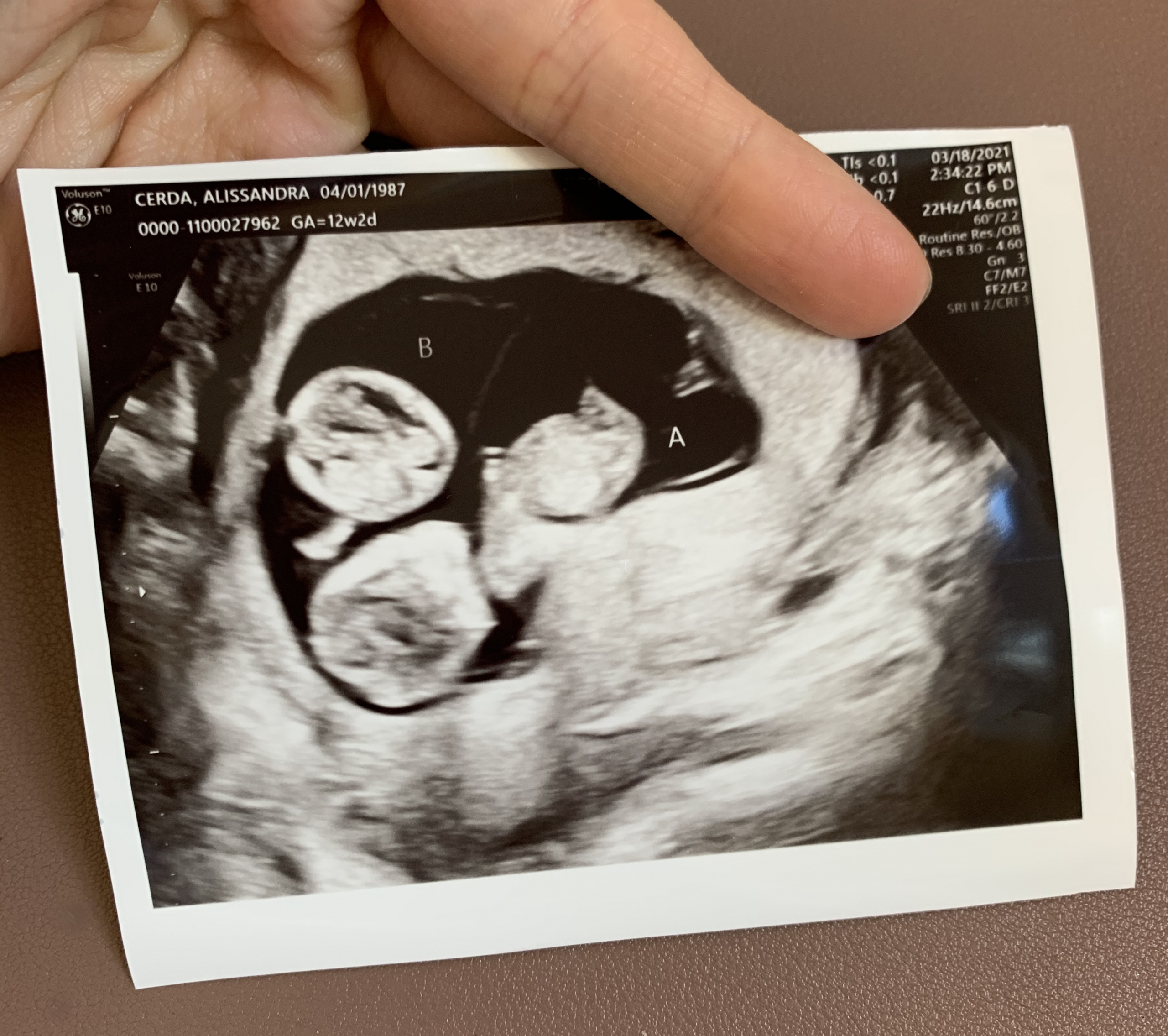 My 12 week ultrasound: twins it is! 